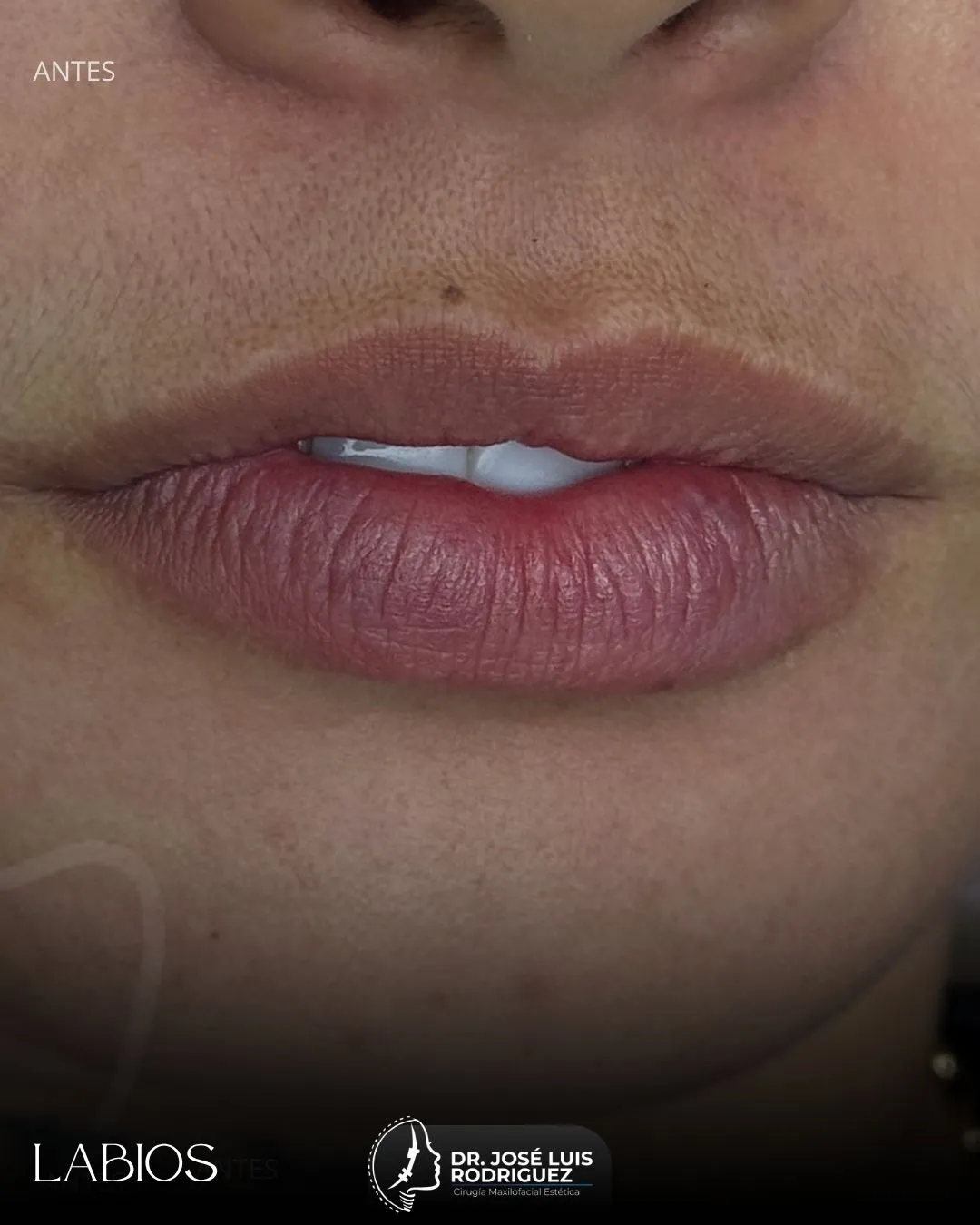 Resultado de relleno de labios - Dr. José Luis Rodríguez, cirujano maxilofacial en Colombia