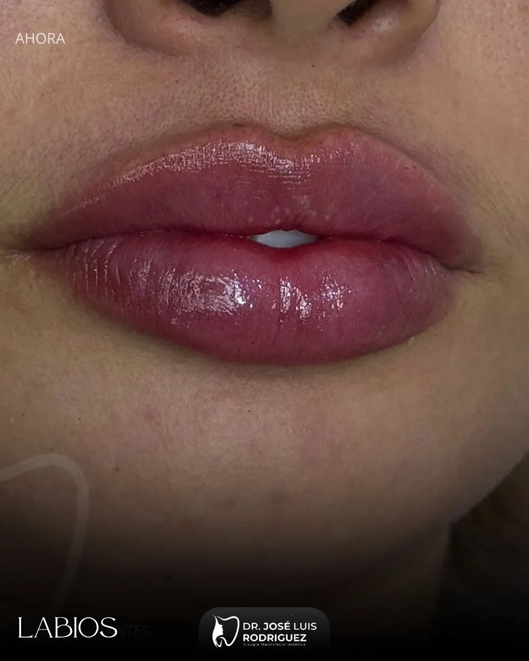 Resultado de relleno de labios - Dr. José Luis Rodríguez, cirujano maxilofacial en Colombia