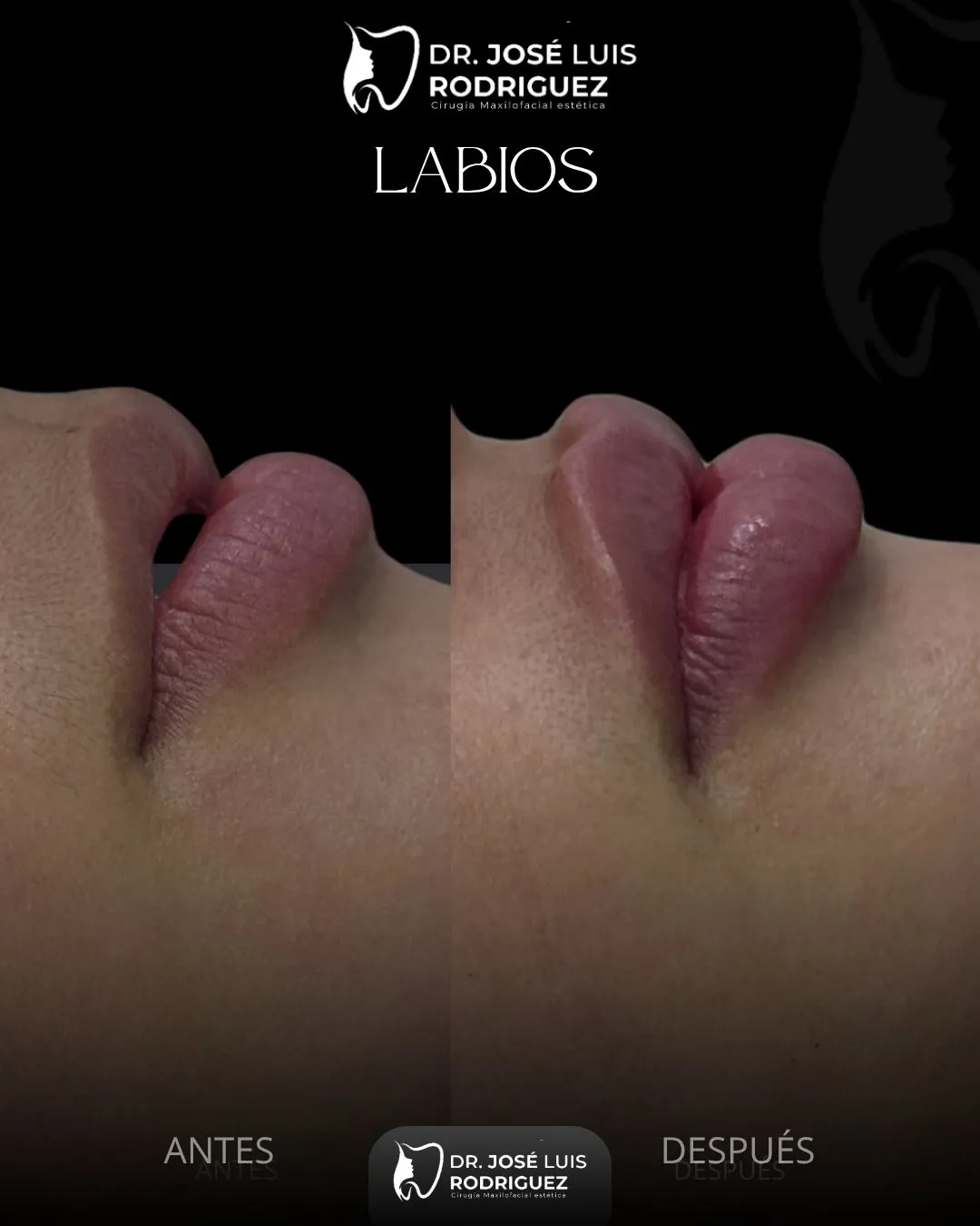 Resultado de relleno de labios - Dr. José Luis Rodríguez, cirujano maxilofacial en Colombia