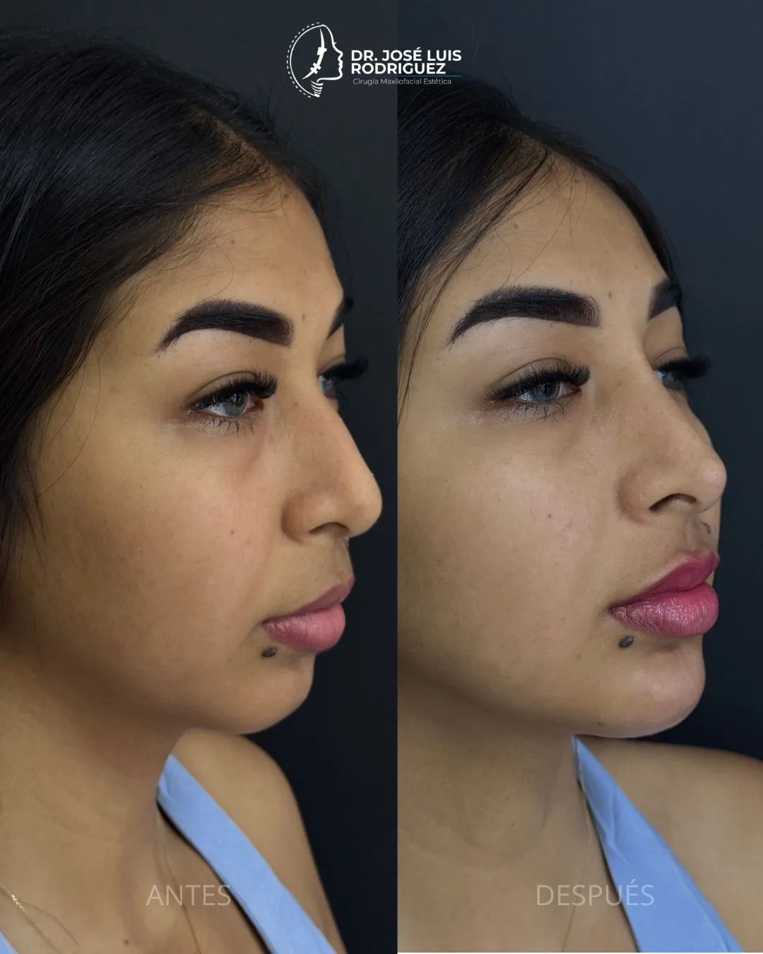 Resultado de relleno de labios - Dr. José Luis Rodríguez, cirujano maxilofacial en Colombia