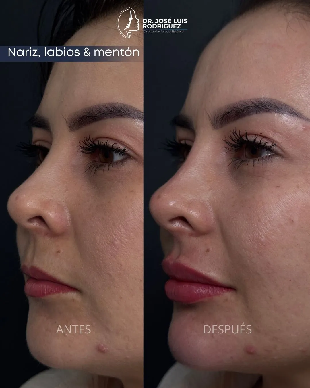 Resultado de relleno de labios - Dr. José Luis Rodríguez, cirujano maxilofacial en Colombia