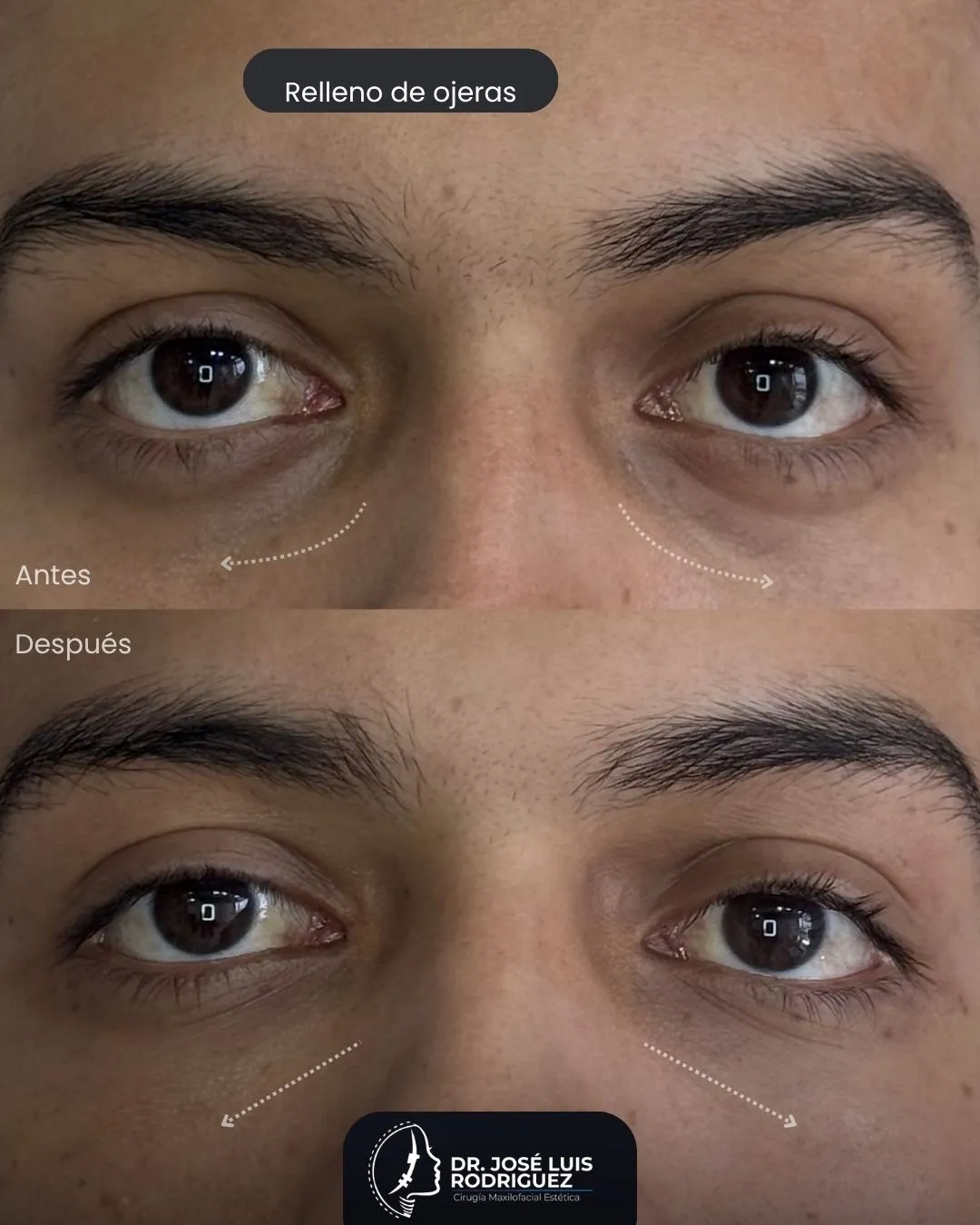 Resultado de relleno de ojeras - Dr. José Luis Rodríguez, cirujano maxilofacial en Colombia