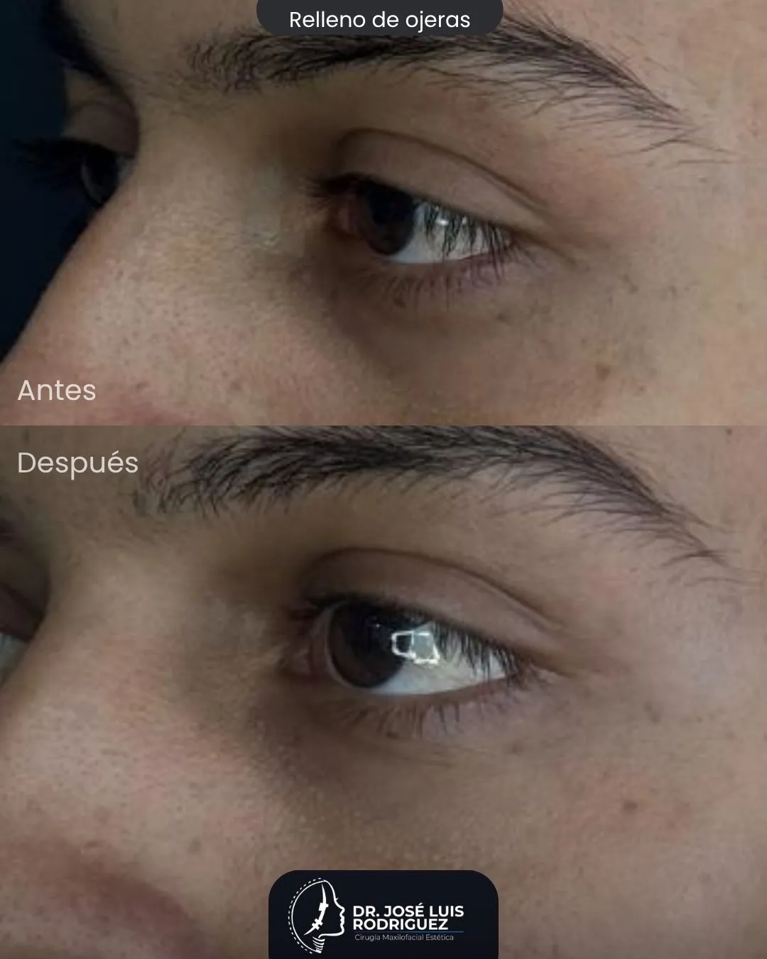 Resultado de relleno de ojeras - Dr. José Luis Rodríguez, cirujano maxilofacial en Colombia