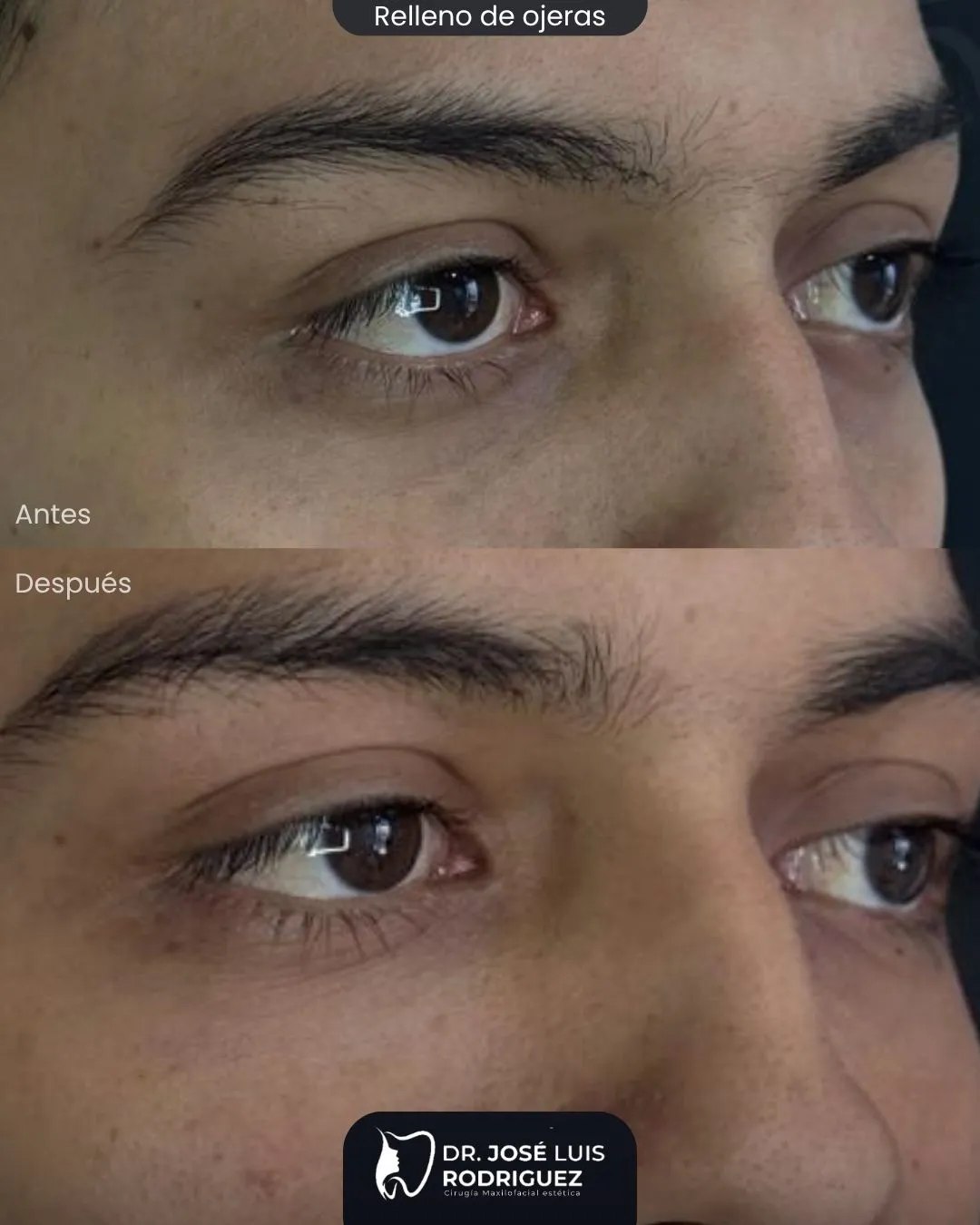 Resultado de relleno de ojeras - Dr. José Luis Rodríguez, cirujano maxilofacial en Colombia