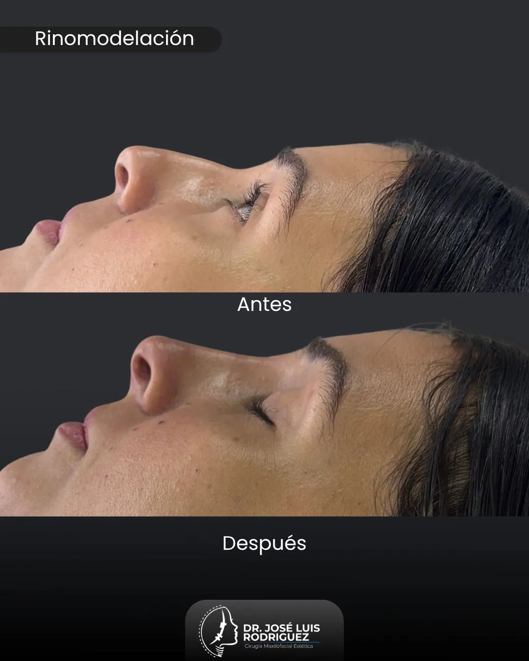 Resultado de rinomodelación - Dr. José Luis Rodríguez, cirujano maxilofacial en Colombia