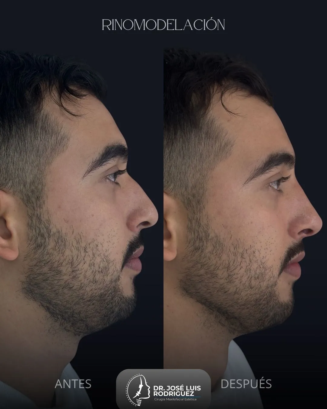 Resultado de rinomodelación - Dr. José Luis Rodríguez, cirujano maxilofacial en Colombia