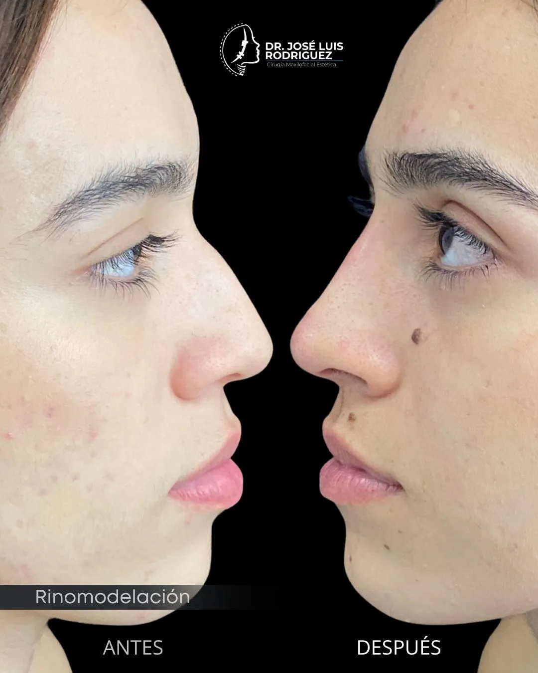 Resultado de rinomodelación - Dr. José Luis Rodríguez, cirujano maxilofacial en Colombia