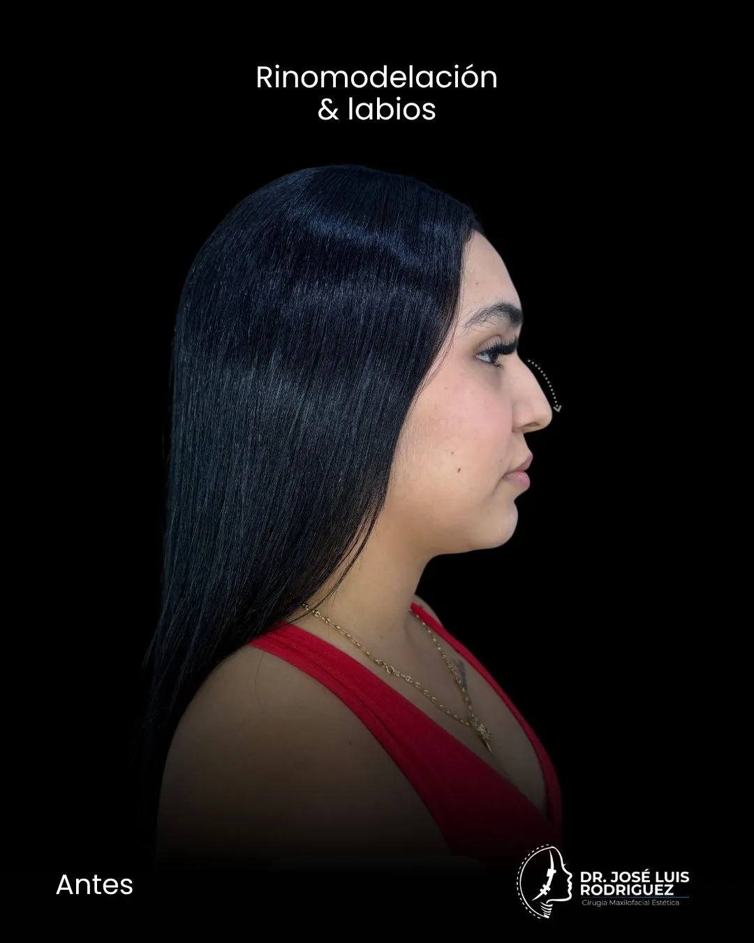 Resultado de rinomodelación - Dr. José Luis Rodríguez, cirujano maxilofacial en Colombia