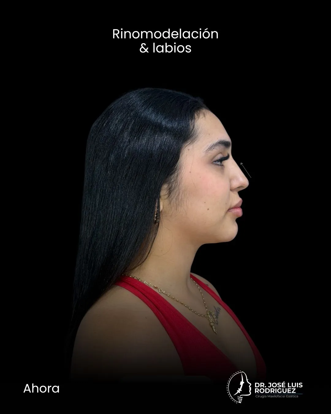 Resultado de rinomodelación - Dr. José Luis Rodríguez, cirujano maxilofacial en Colombia