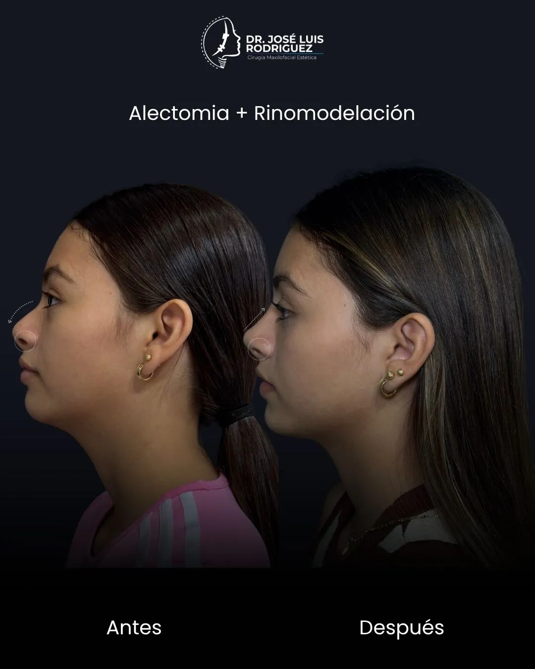 Resultado de rinomodelación - Dr. José Luis Rodríguez, cirujano maxilofacial en Colombia