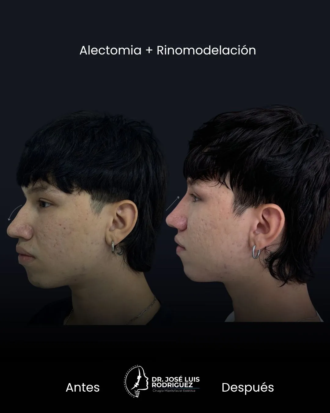 Resultado de rinomodelación - Dr. José Luis Rodríguez, cirujano maxilofacial en Colombia