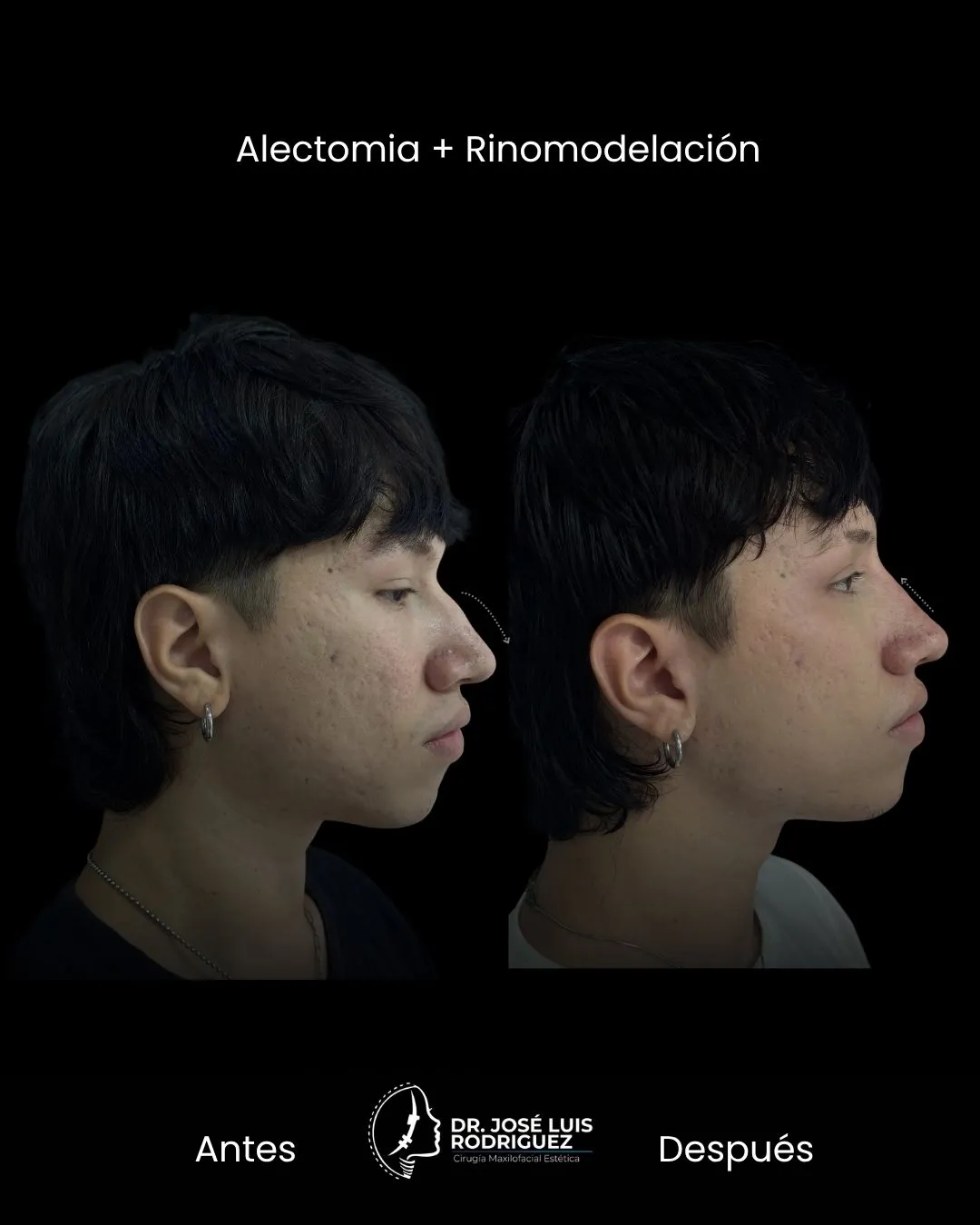 Resultado de rinomodelación - Dr. José Luis Rodríguez, cirujano maxilofacial en Colombia