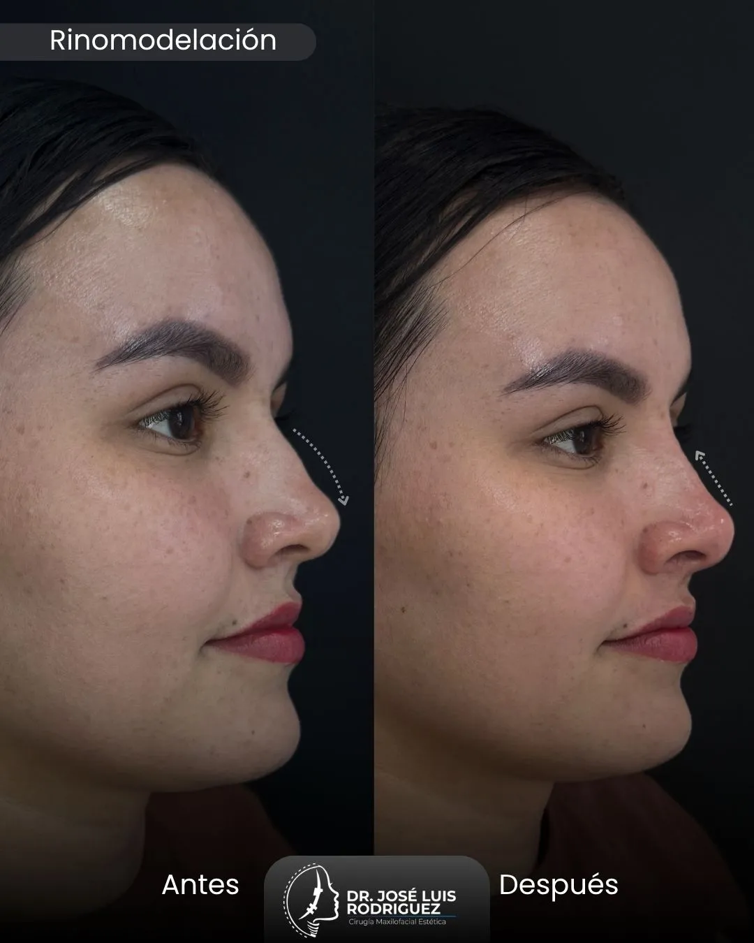 Resultado de rinomodelación - Dr. José Luis Rodríguez, cirujano maxilofacial en Colombia
