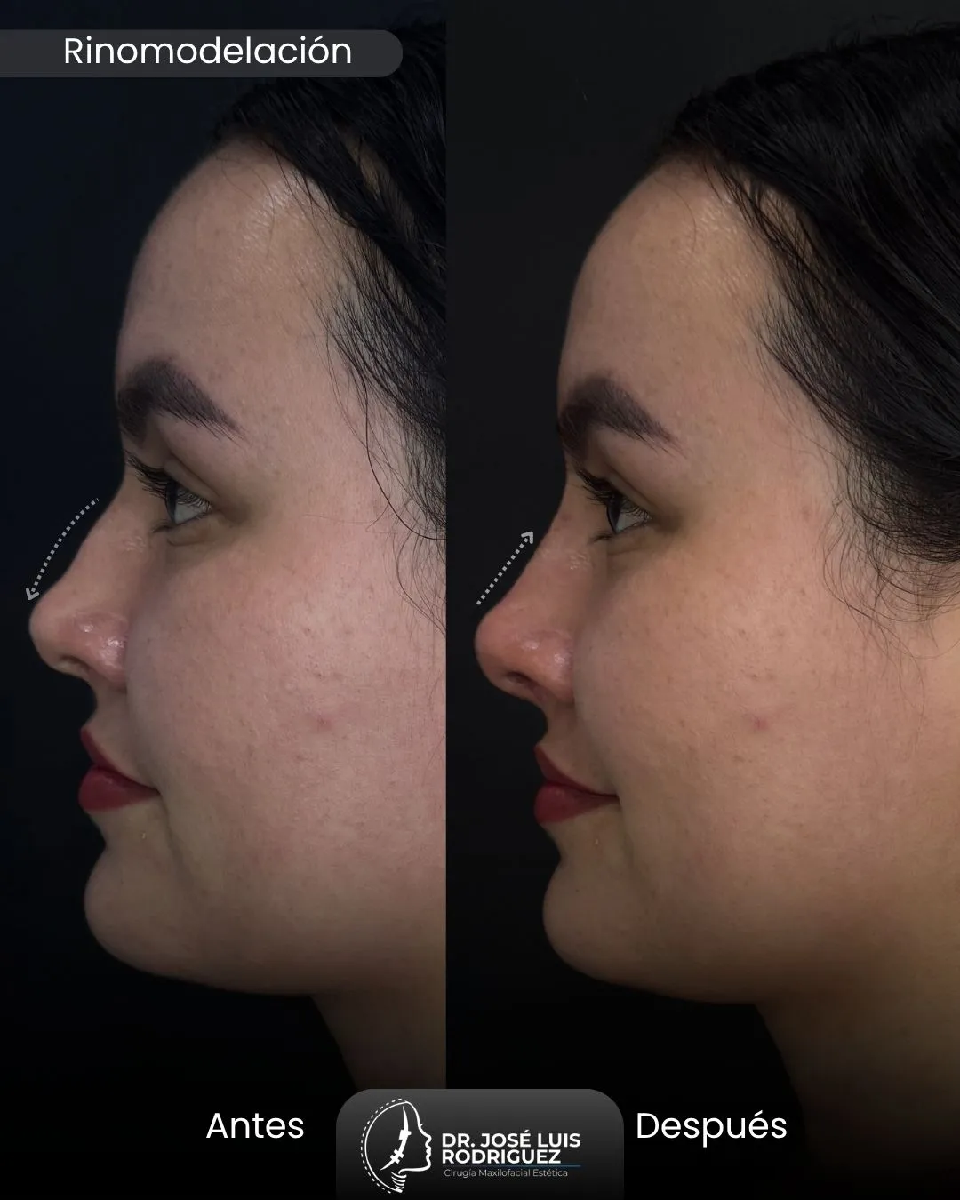 Resultado de rinomodelación - Dr. José Luis Rodríguez, cirujano maxilofacial en Colombia