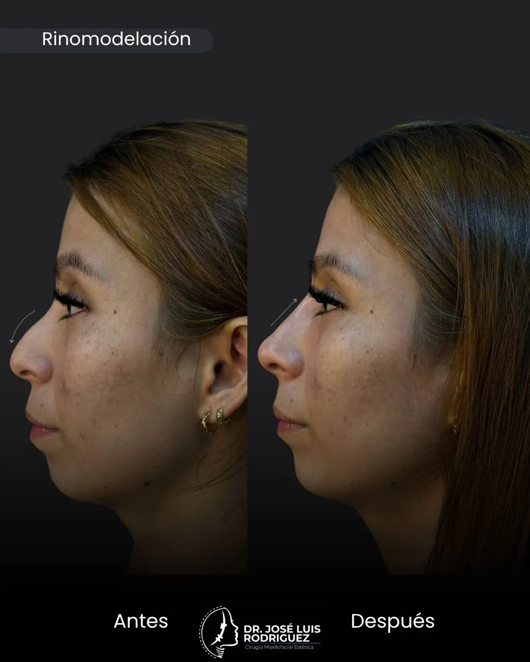 Resultado de rinomodelación - Dr. José Luis Rodríguez, cirujano maxilofacial en Colombia