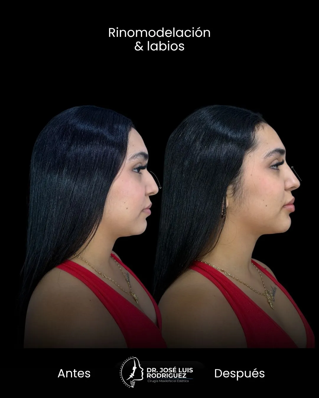 Resultado de rinomodelación - Dr. José Luis Rodríguez, cirujano maxilofacial en Colombia